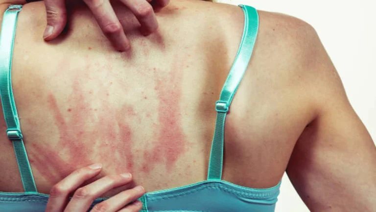 Chronic Skin Conditions Why Your Rash Keeps Coming Back