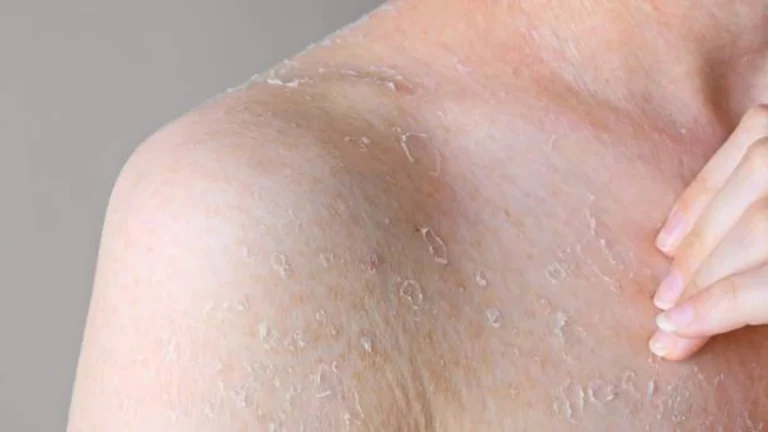 Dry Flaky Skin Causes Why Your Skin Won't Stop Peeling