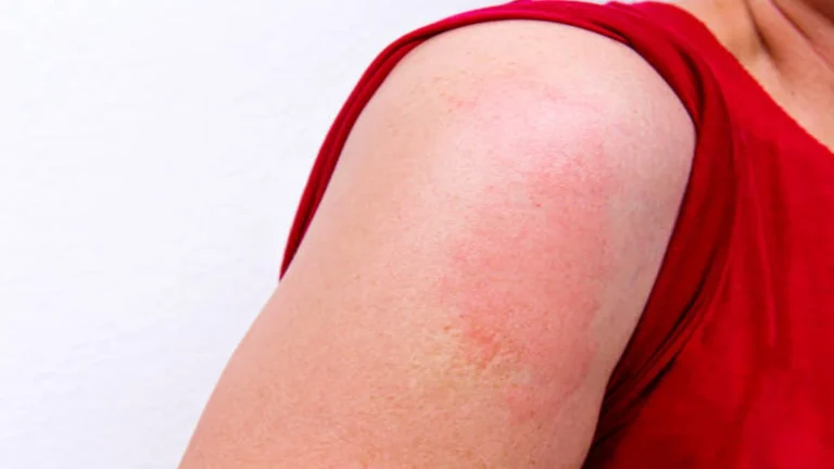 Red Skin Patches Not Itchy What They Mean and When to Worry