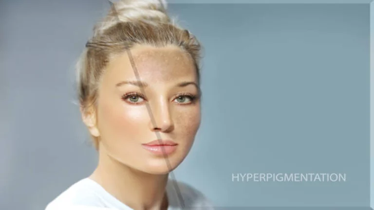 What Causes Skin Hyperpigmentation A Complete Breakdown